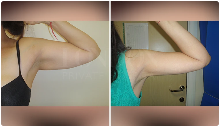 vaser lipo on arms before and after patient-v1