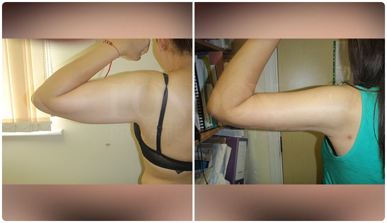 vaser lipo on arms before and after patient-v2