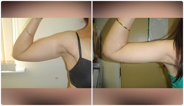 vaser lipo on arms before and after patient