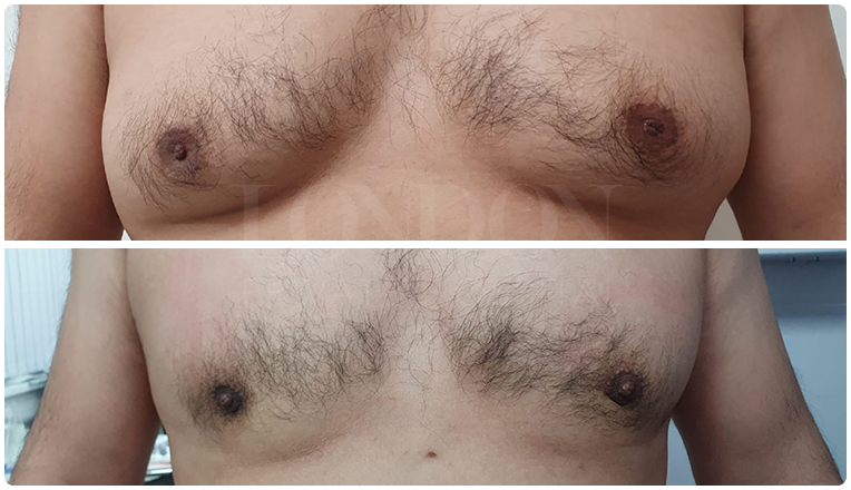 gynecomastia before and after patient -1