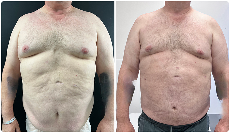 gynecomastia before and after patient -10-v1