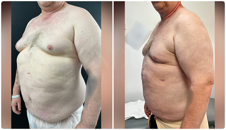 gynecomastia before and after patient -10