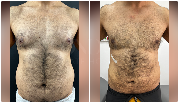 gynecomastia before and after patient -11