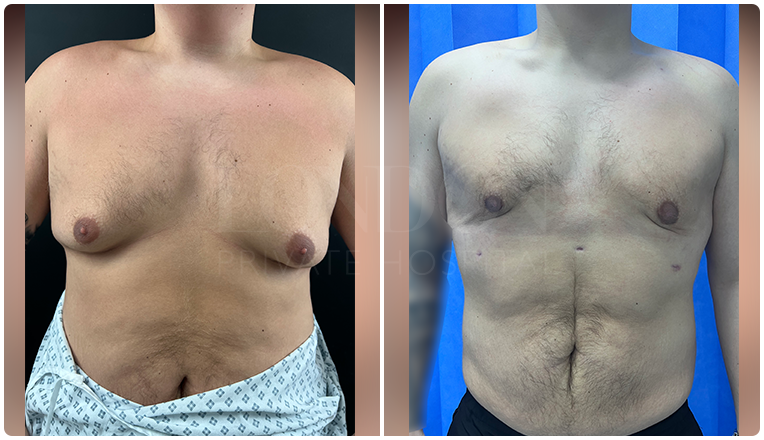 gynecomastia before and after patient -12