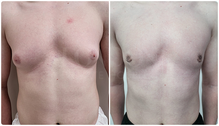 gynecomastia before and after patient -2