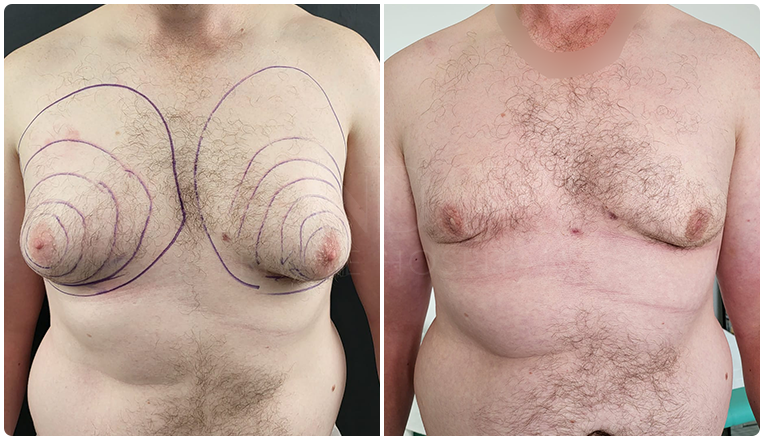 gynecomastia before and after patient -3