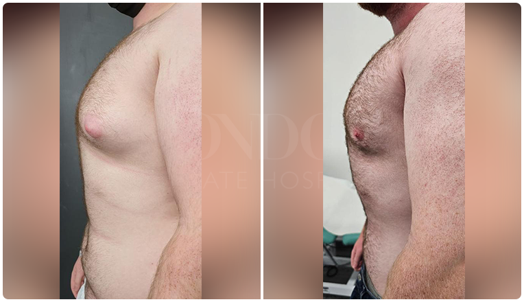 gynecomastia before and after patient -4-v1