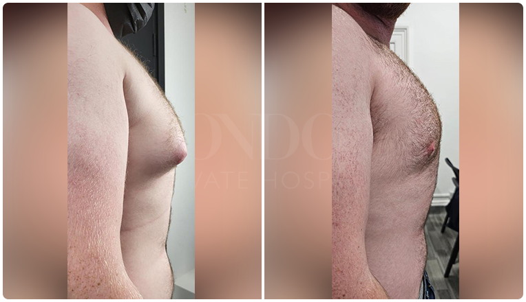 gynecomastia before and after patient -4-v2