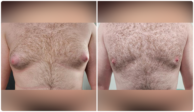 gynecomastia before and after patient -4