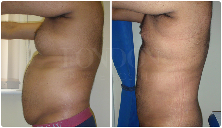 gynecomastia before and after patient -5-v1