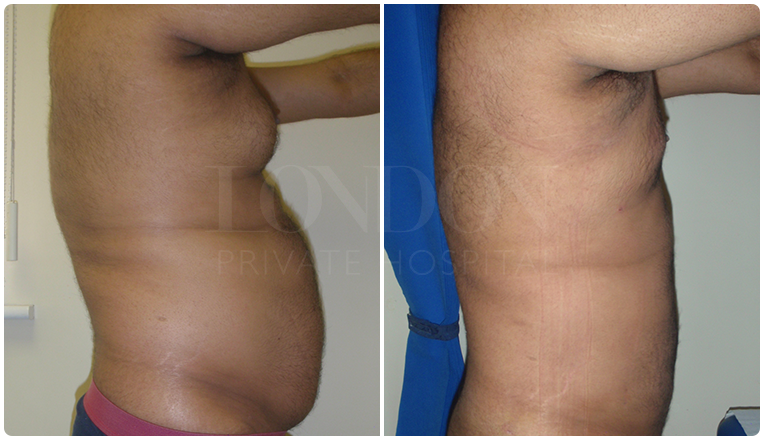 gynecomastia before and after patient -5-v2