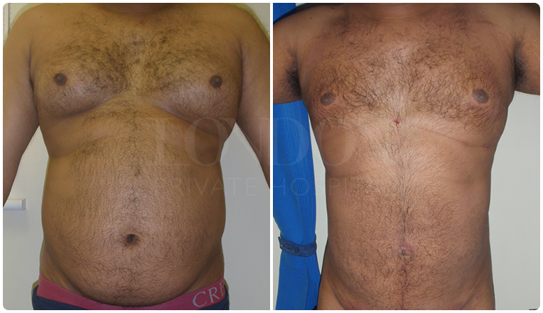 gynecomastia before and after patient -5