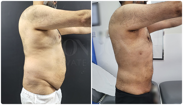 gynecomastia before and after patient -6