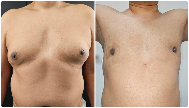 gynecomastia before and after patient -7