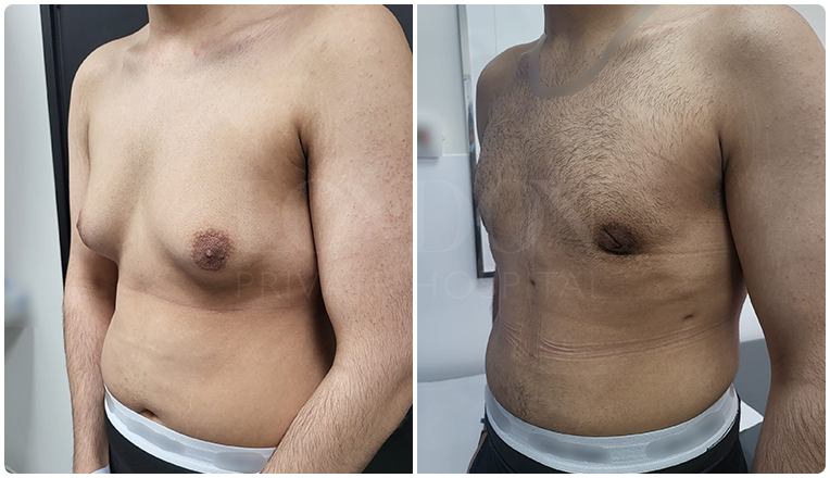 gynecomastia before and after patient -8-v1