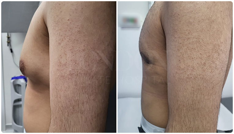 gynecomastia before and after patient -8-v2