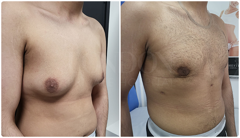 gynecomastia before and after patient -8-v3