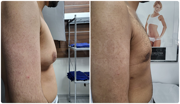 gynecomastia before and after patient -8-v4