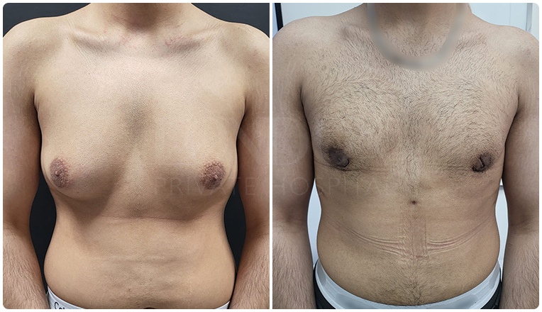 gynecomastia before and after patient -8