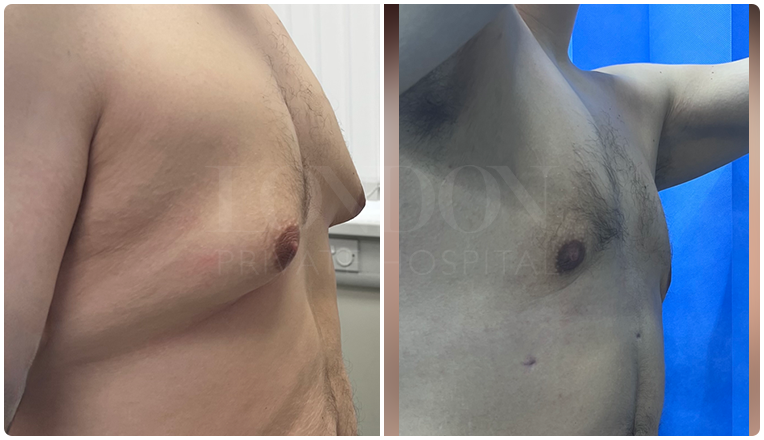 gynecomastia before and after patient -9