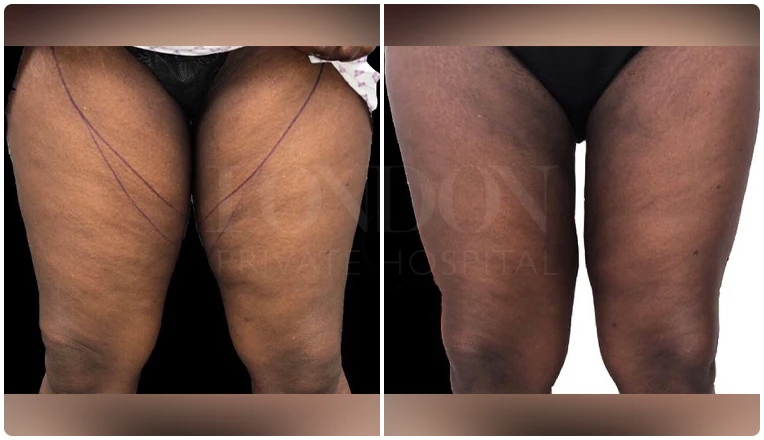 thigh vaser lipo before after patient result-1-v1