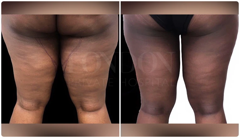 thigh vaser lipo before after patient result-1