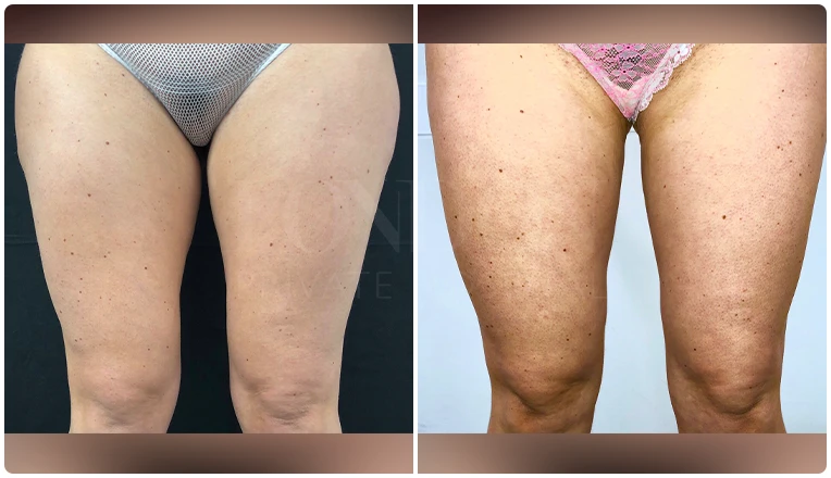 thigh vaser lipo before after patient result-2