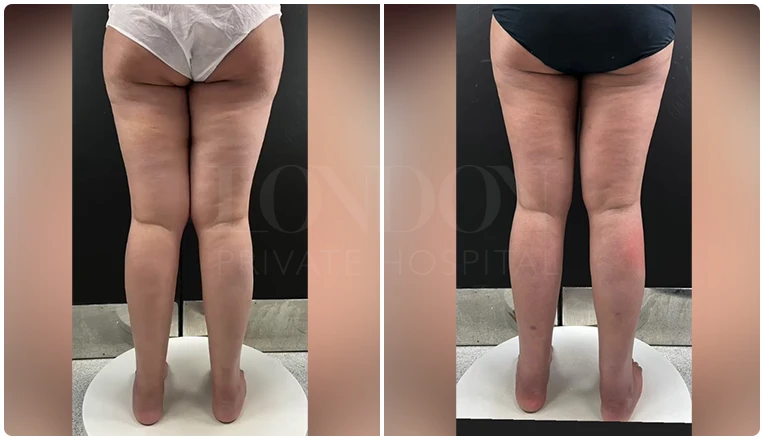 thigh vaser liposuction before after patient result-1-v1