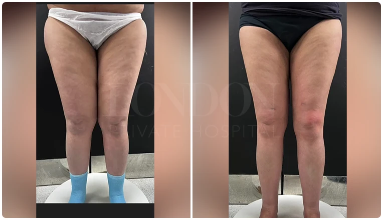 thigh vaser liposuction before after patient result-1