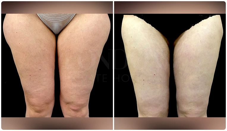 thigh vaser liposuction before after patient result-2