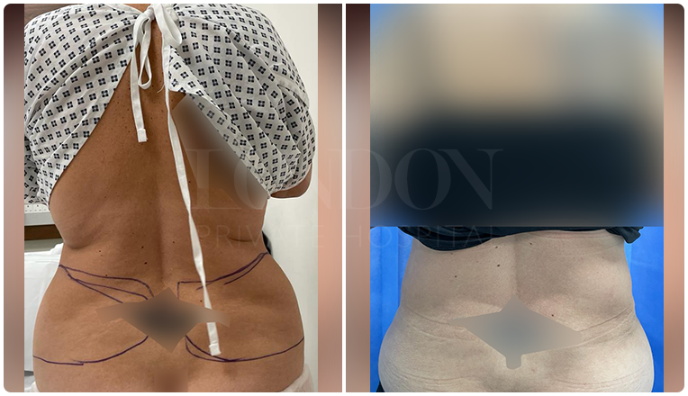 tummy tuck before and after result patient -1-v1