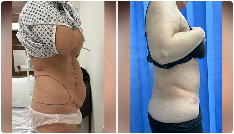 tummy tuck before and after result patient -1-v2