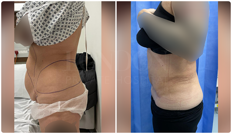 tummy tuck before and after result patient -1-v3