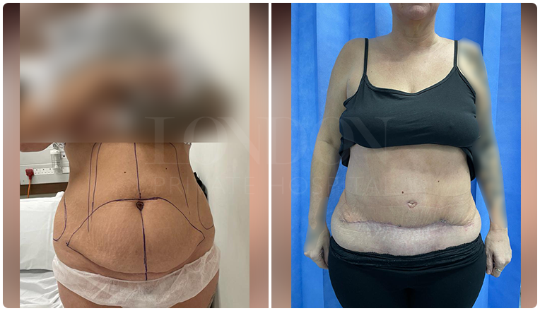 tummy tuck before and after result patient -1