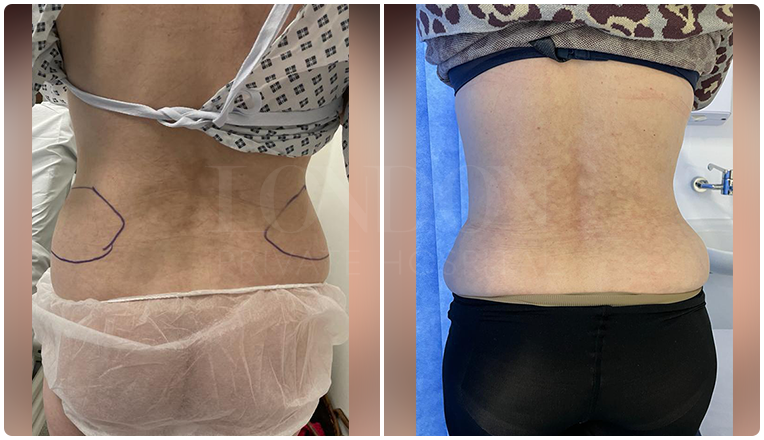 tummy tuck before and after result patient -2-v1