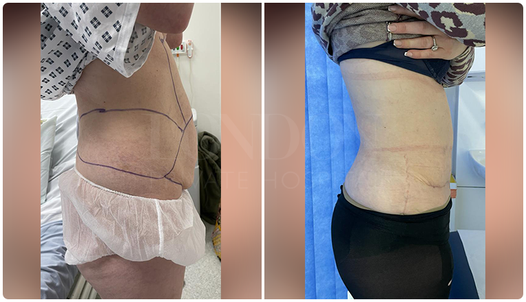 tummy tuck before and after result patient -2-v2