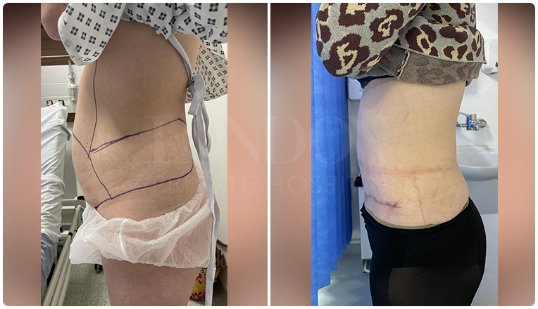 tummy tuck before and after result patient -2-v3