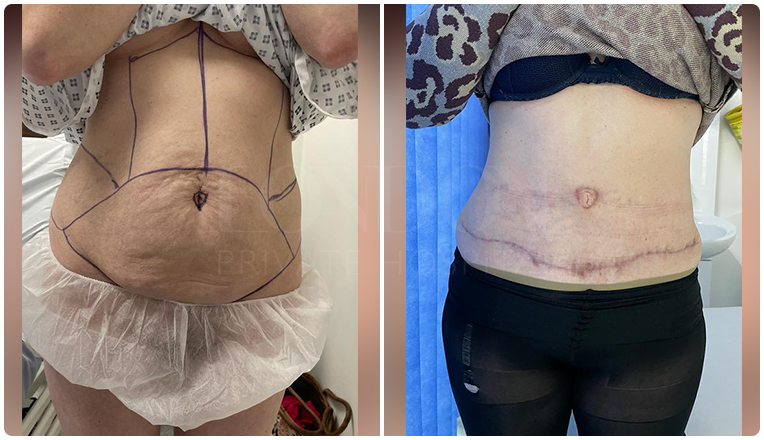 tummy tuck before and after result patient -2