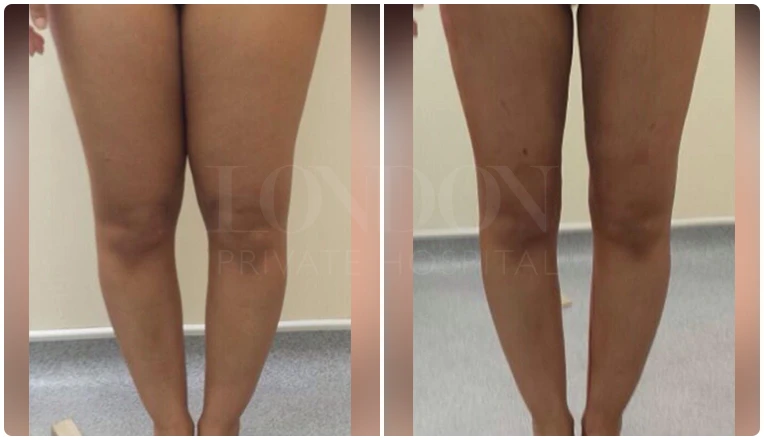 vaser lipo legs before and after patient result-1