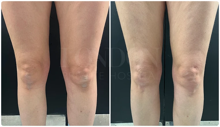 vaser lipo legs before and after patient result-2