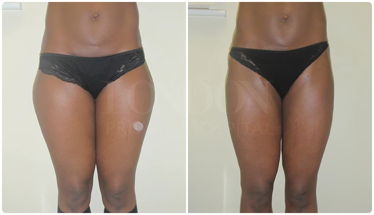 vaser lipo thighs before after patient result-1-v1