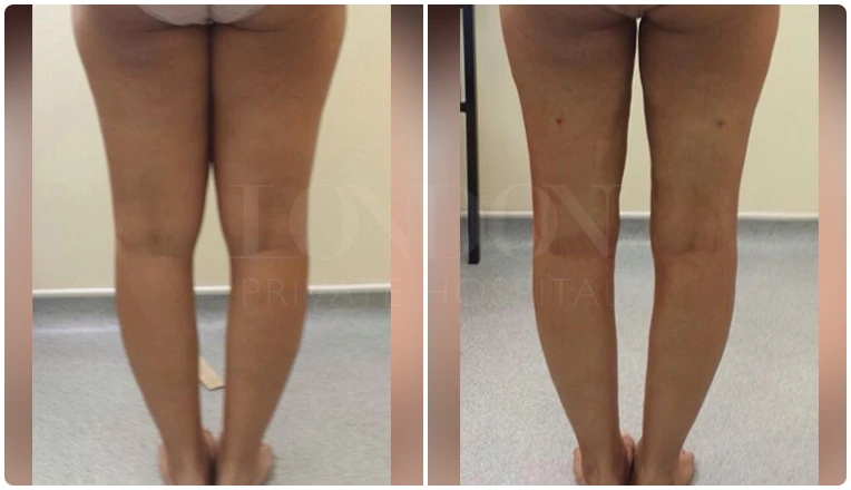 vaser lipo thighs before after patient result-1-v2