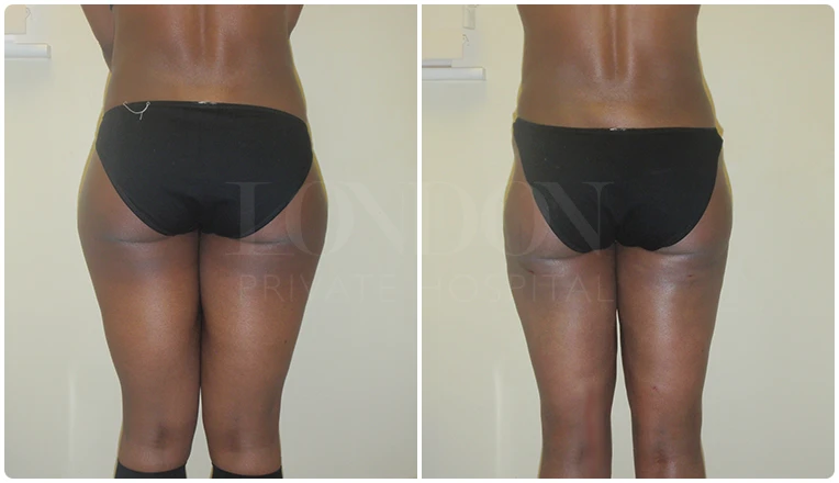 vaser lipo thighs before after patient result-1