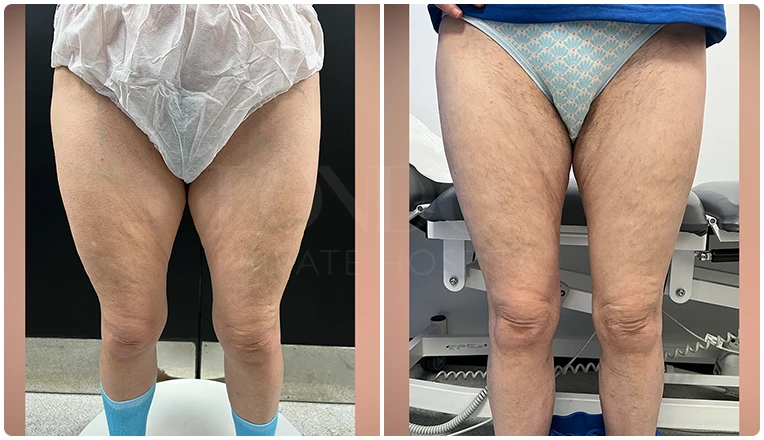 vaser lipo thighs before after patient result-2