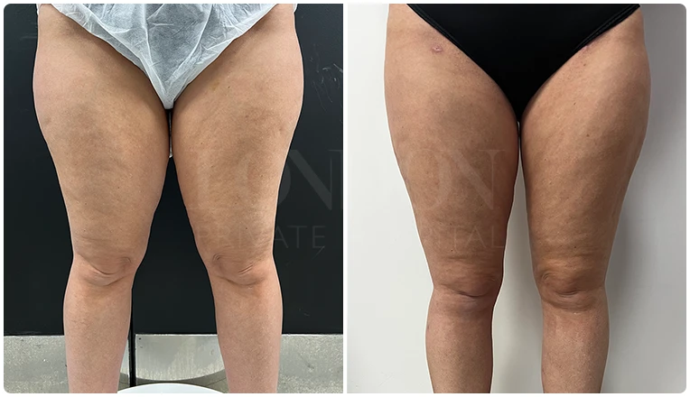 vaser lipo thighs before after patient result-3