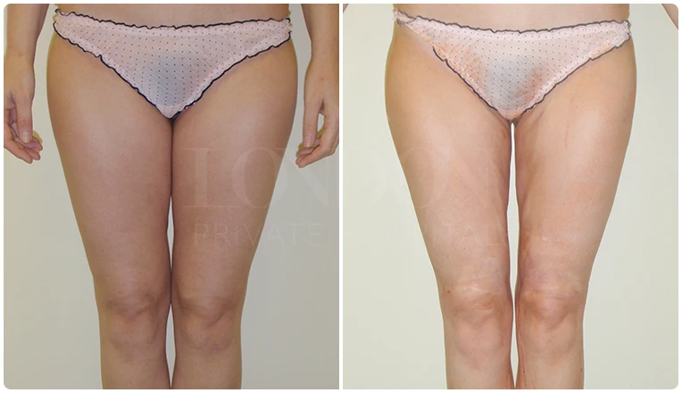 vaser liposuction legs before and after patient result-1