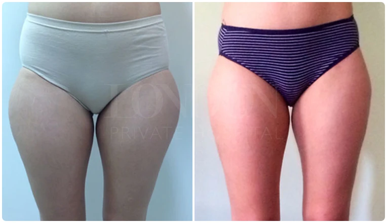 vaser liposuction legs before and after patient result-2