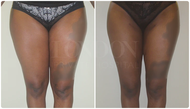 vaser liposuction thighs before after patient result-1-v1