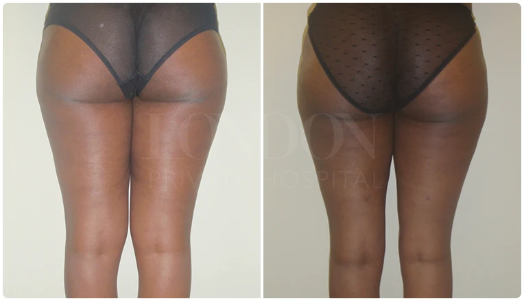 vaser liposuction thighs before after patient result-1