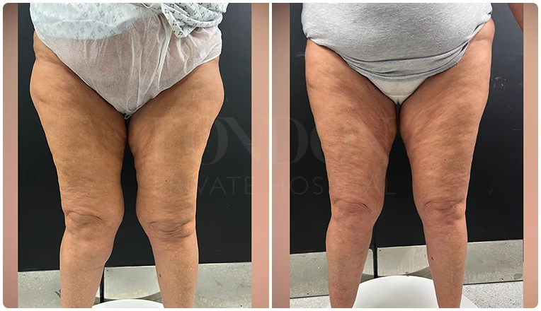 vaser liposuction thighs before after patient result-2